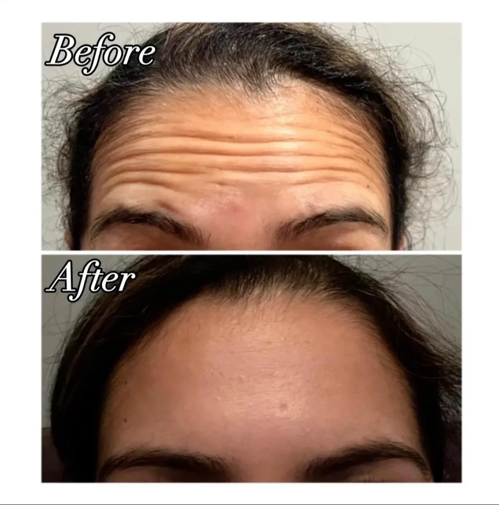 Comparison of forehead with noticeable lines pre-treatment and smooth appearance post wrinkle relaxer treatment.