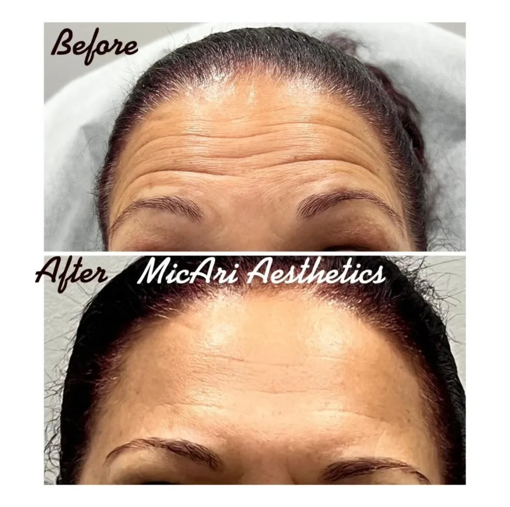 Top: visible forehead wrinkles; bottom: smoothed forehead after wrinkle relaxer treatment
