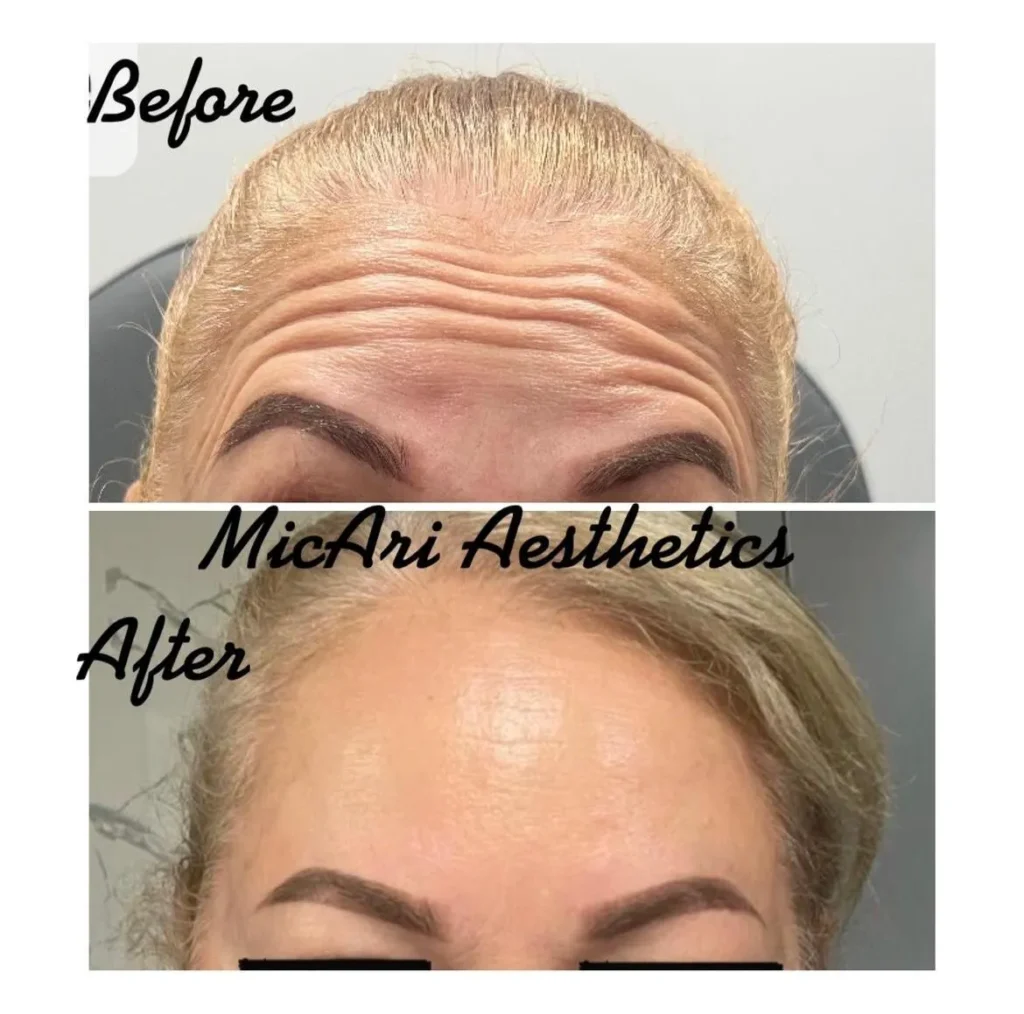 Side-by-side before and after image of a woman’s forehead showing reduced wrinkles and smoother skin post-treatment.