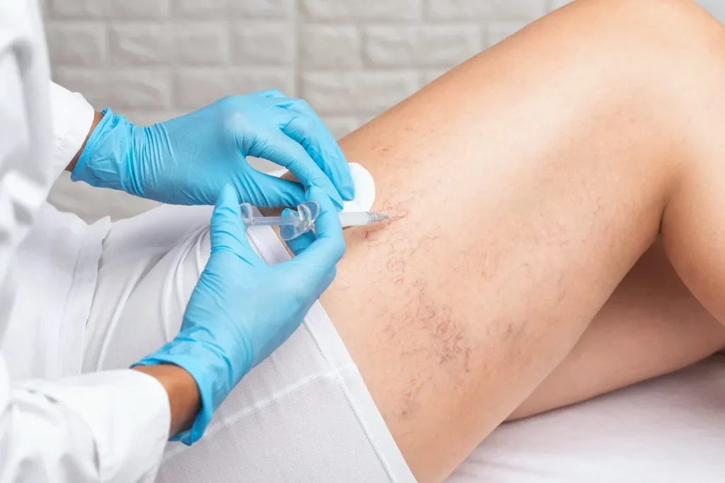 A patient in Bellmore is receiving Spider Vein Treatment on their leg.