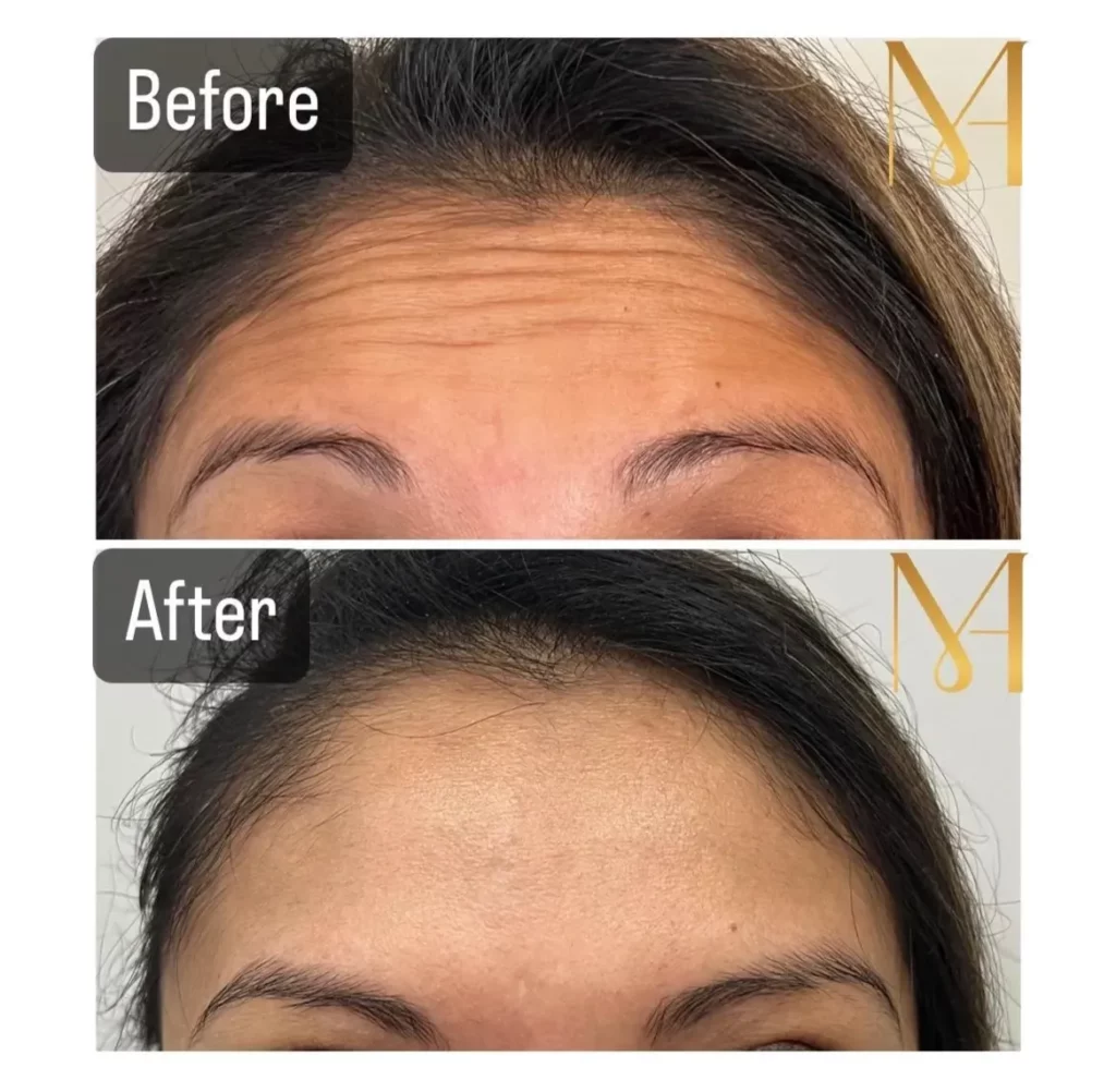Before and After Treatment Images of Wrinkle Reducers