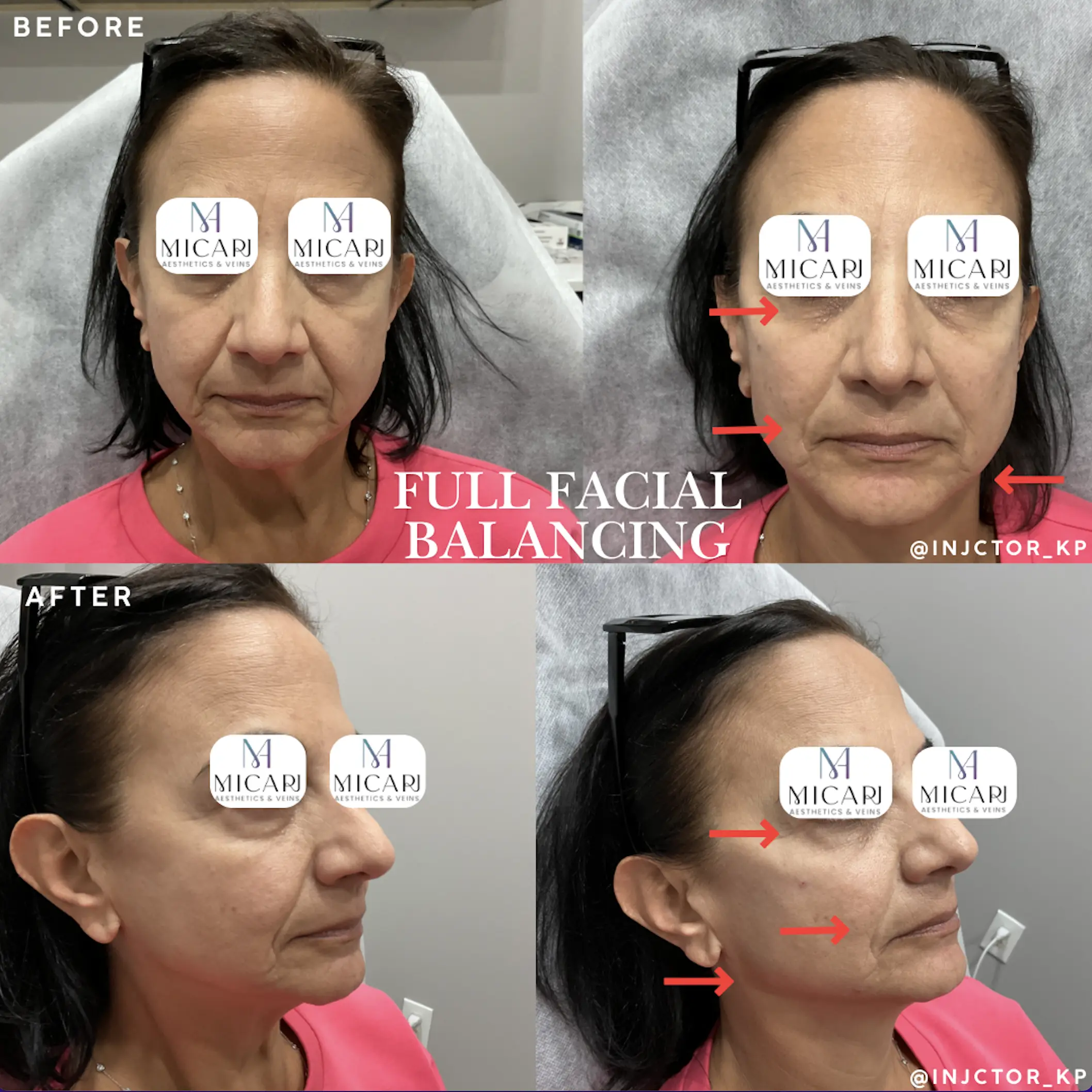 Full Facial Balancing Before After Micari Aesthetics Veins Bellmore Long Island