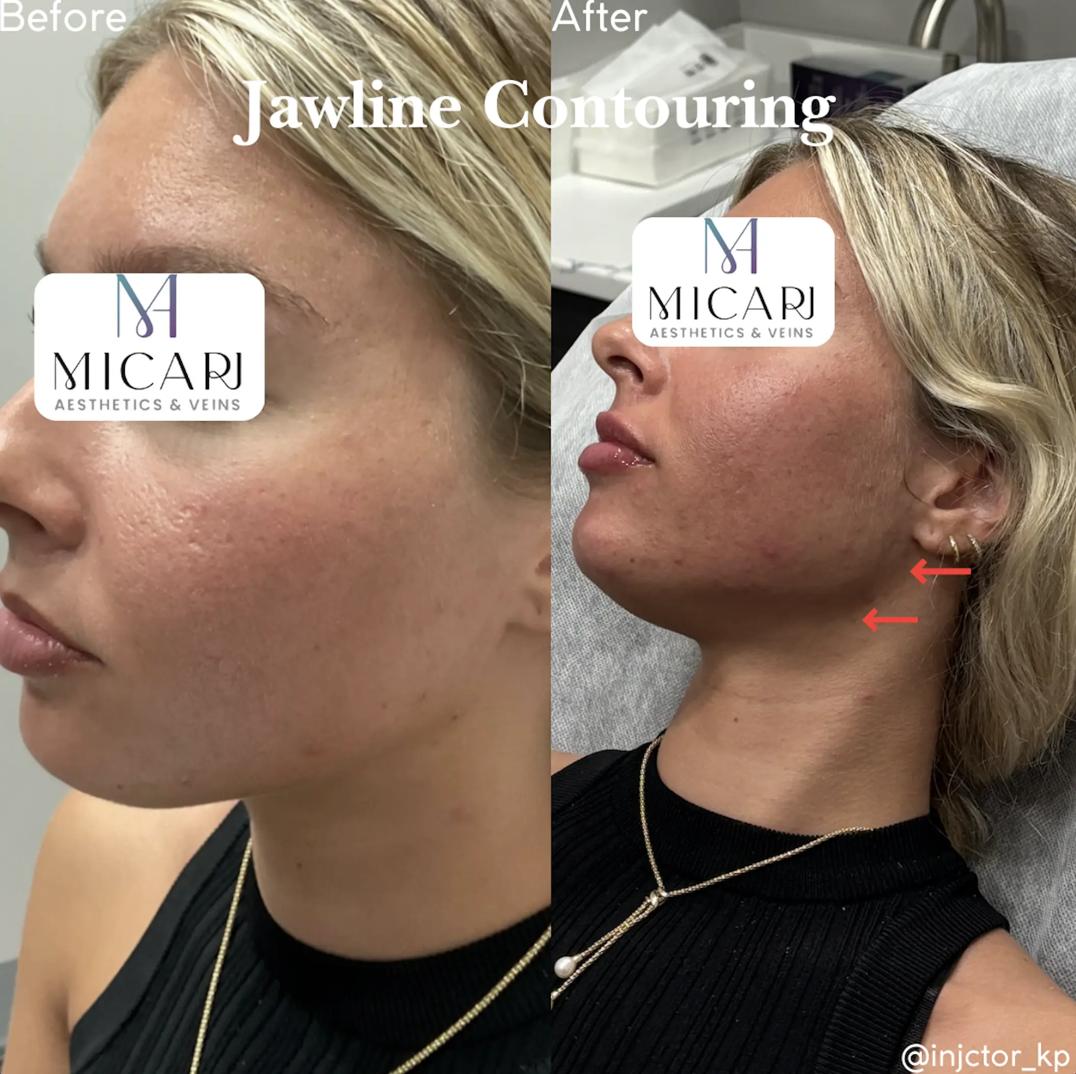 Jawline Contouring Before and After results at Micari Aesthetics Veins Bellmore, Long Island