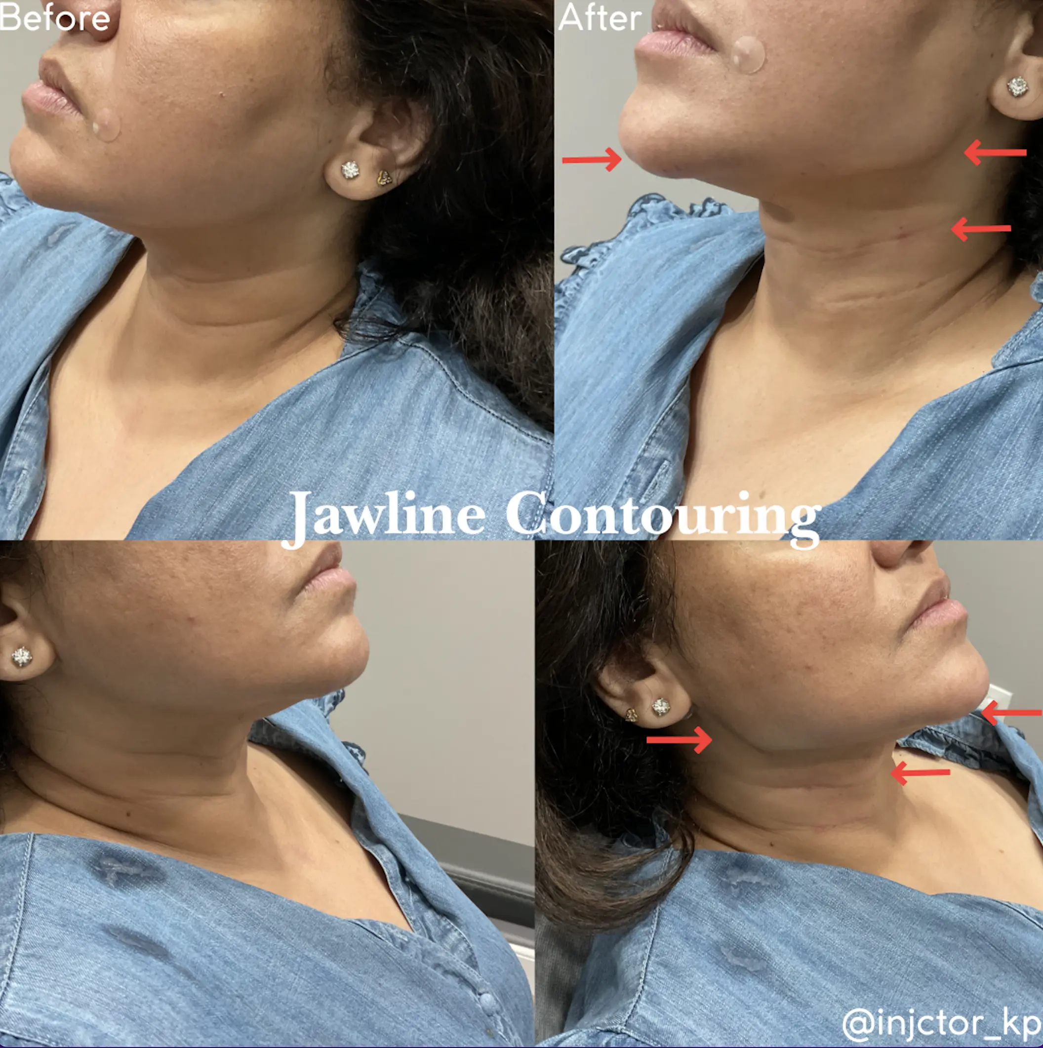 Kybella jawline contouring before and after results at MICARI Aesthetics & Veins in Bellmore, Long Island