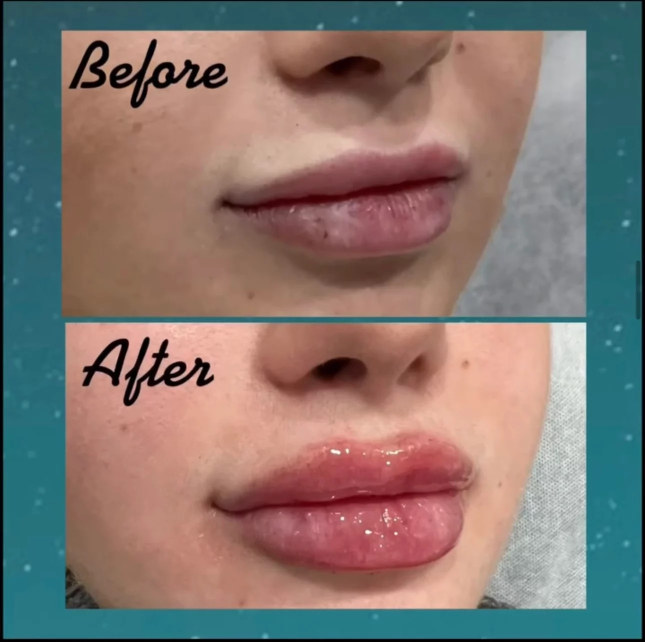 Lip Filler Before & After photo at Micari Aesthetics and Veins in Bellmore, Long Island
