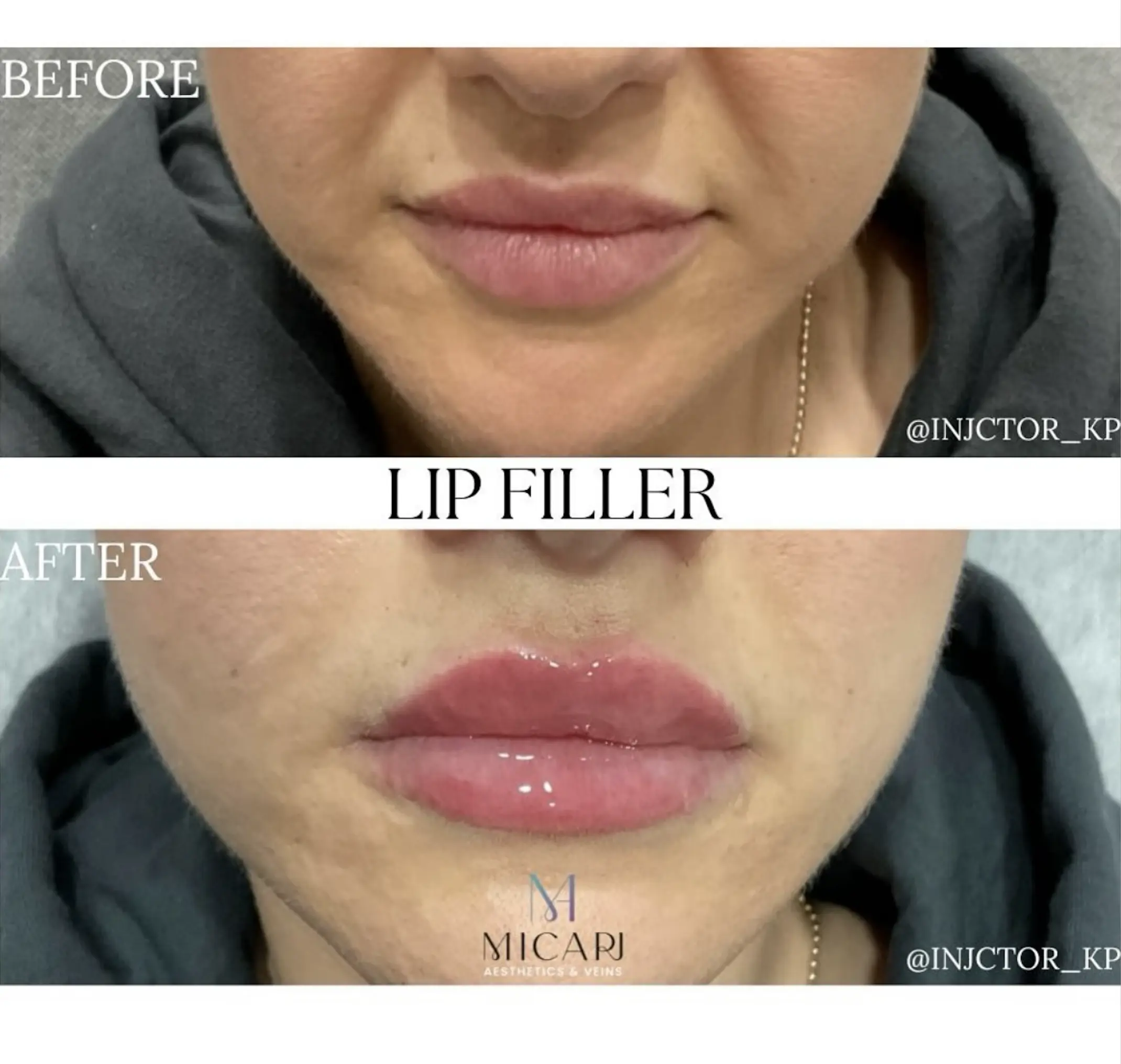 Lip Filler Results Before and After results at Micari Aesthetics Veins in Bellmore, Long Island