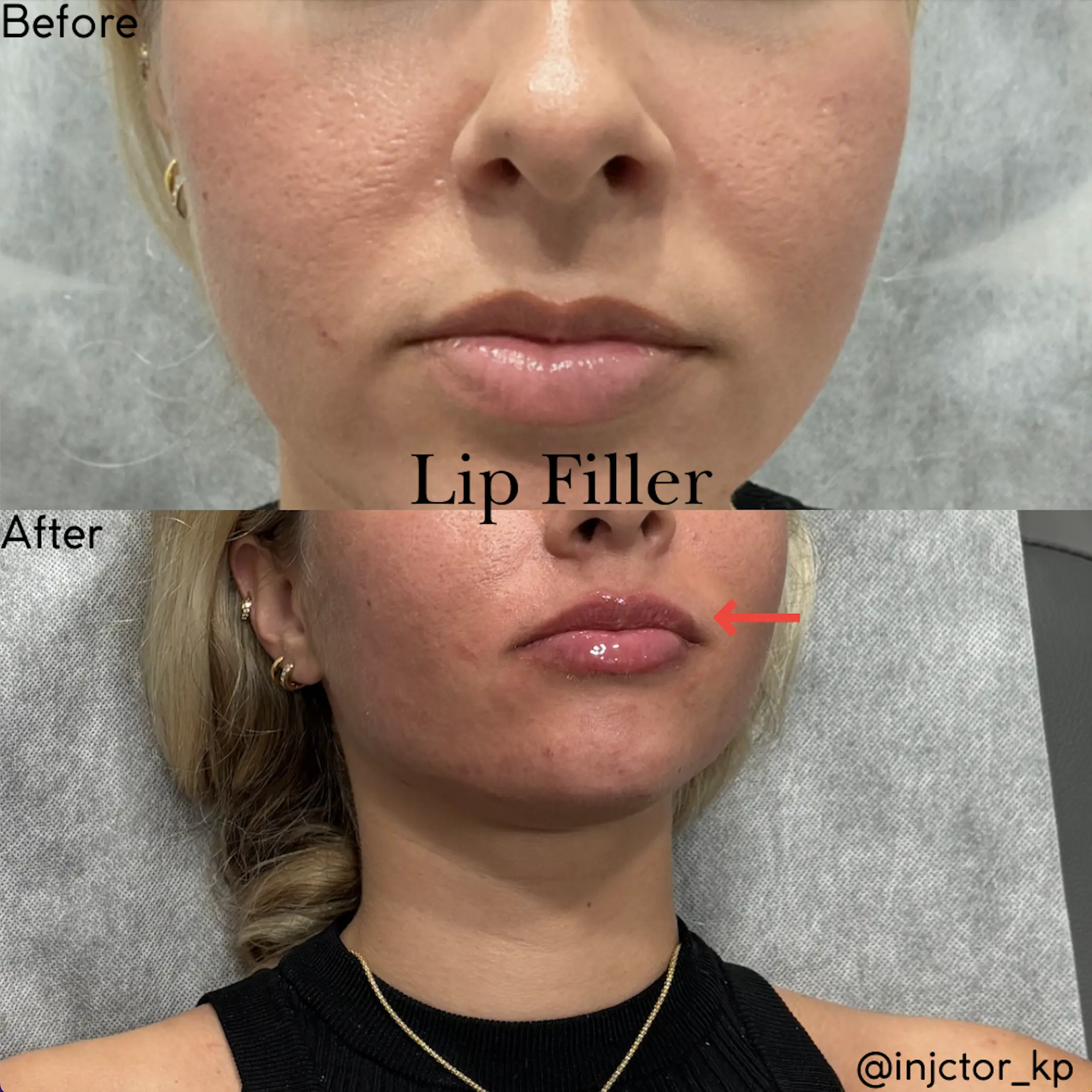 Lip Fillers Before and After results at Micari Aesthetics Veins in Bellmore, Long Island.