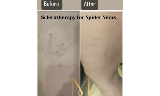 Sclerotherapy for Spider Veins