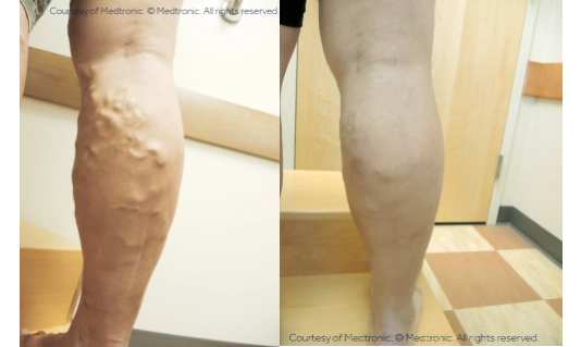 Varicose Vein Before After