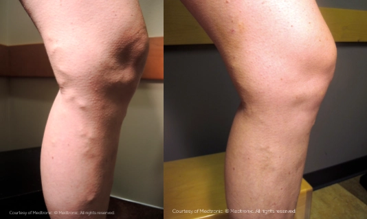 Varicose Vein Before After 2