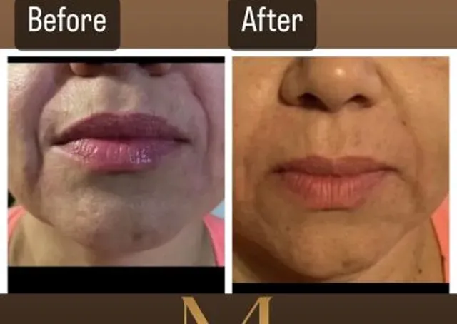 Before-and-After-Nasolabial-Fold-Fillers-a