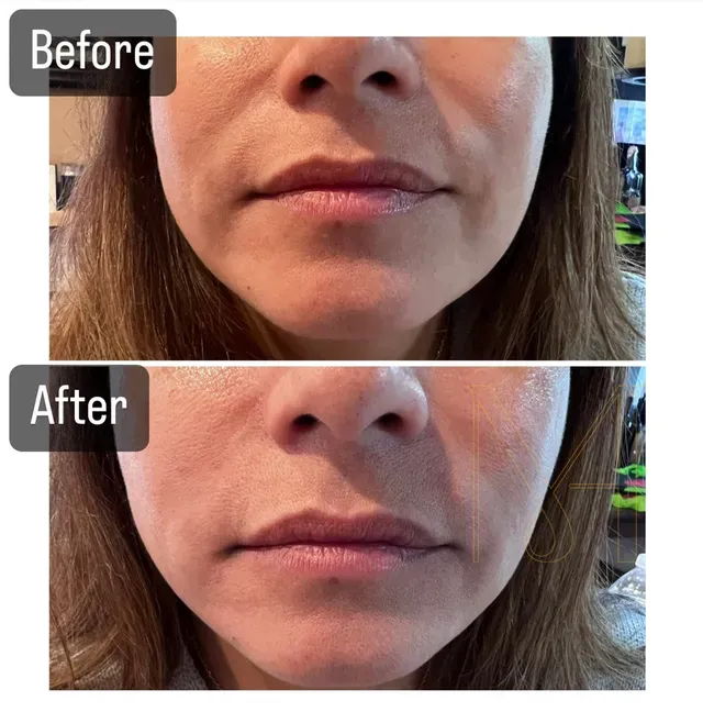 Before-and-after-Nasolabial-Fold-Fillers