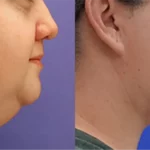Dr Dayan - Quanutm Lower Face