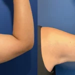 FH_QuantumRF_Arms_Female_RArm_Back_TM