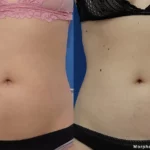 Morpheus8_Abdomen_RWestreich