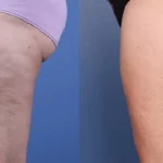 Morpheus8_Before&After (1)