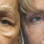 Morpheus8_Before&After (10)