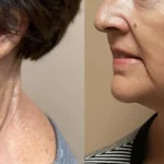 Morpheus8_Before&After (11)