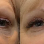 Morpheus8_Before&After (12)