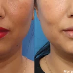 Morpheus8_Before&After (13)