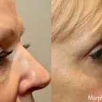Morpheus8_Before&After (14)