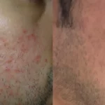Morpheus8_Before&After