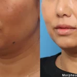 Morpheus8_Before&After (16)