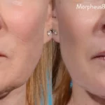 Morpheus8_Before&After (17)
