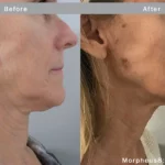 Morpheus8_Before&After (3)