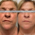Morpheus8_Before&After (4)