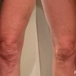 Morpheus8_Before&After (5)