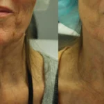 Morpheus8_Before&After (7)