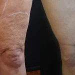 Morpheus8_Before&After (8)