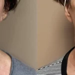 Morpheus8_Before&After (9)