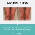 Morpheus8_BeforeAndAfter_SocialPost (1)