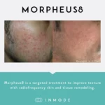 Morpheus8_BeforeAndAfter_SocialPost (2)