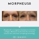 Morpheus8_BeforeAndAfter_SocialPost (4)