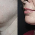 PR_QuantumRF_Jowl_Female_LSide_TM (1)