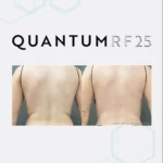 Q25 Lower Back Female