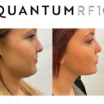 Quantum 10 - lower face - female-1