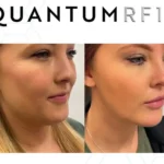 Quantum 10 - lower face - female-2