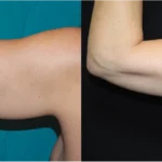 Quantum Arms