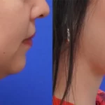 Quantum Lower Face