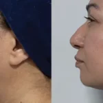 Quantum - Lower Face -female