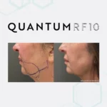 lower face femal quantum 10