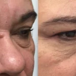 morpheus8-before-after-dr-s-farhang-preview-1