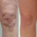 morpheus8-before-after-premier-med-spa-of-lufkin-preview-1