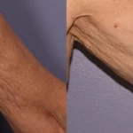 morphues8-before-after-dr-g-stevens-preview-1 (2)