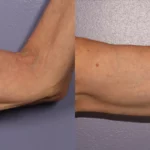 morphues8-before-after-dr-g-stevens-preview-2 (1)