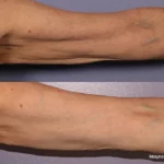 morphues8-before-after-dr-g-stevens-preview-3 (1)